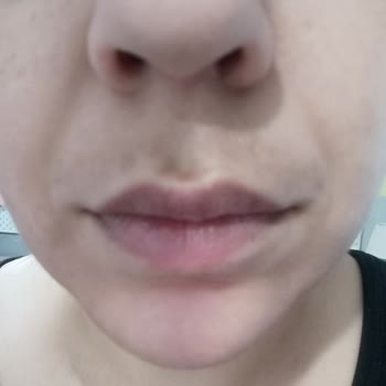 Zorla Ürün Satışı Ve Fazla Ücretlendirme Sonrası Ciddi Yanık Ve Sürekli Rahatsız Edilme