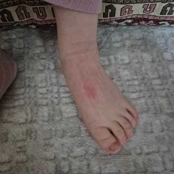 Kızarıklığa Neden Olan Çocuk Ayakkabısının İade Ve Değişim Talebi Reddedildi