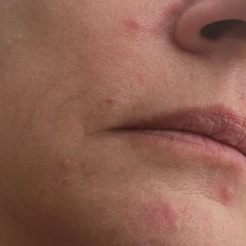Skinceuticals Serumu Kullanımının Ardından Şiddetli Alerjik Akne Ve Cilt Tahrişi