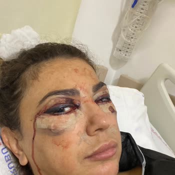 Göz Kapaklarımda Uzun Süreli Şişlik Ve Asimetri İçin Hızlı Çözüm Talebi