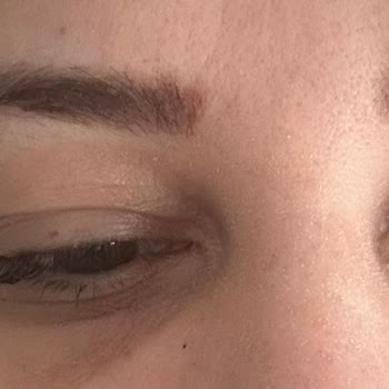 Larissa Clinic Hem Estetik Hem Psikolojik Olarak Olumsuz Etkilenmiş Durumdayım