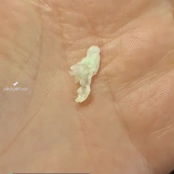 Uğur Mumcu Burger King İçinden Çıkan Yabancı Madde