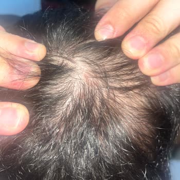 Vichy Dercos Şampuanı Kullanım Sonrası Kafa Derisinde Kızarıklık Ve Kaşıntı