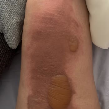 Fakir Çay Makinesinin Kulp Yanması Sonucu Şiddetli Yanık Ve Tedavi Masrafları Talebi