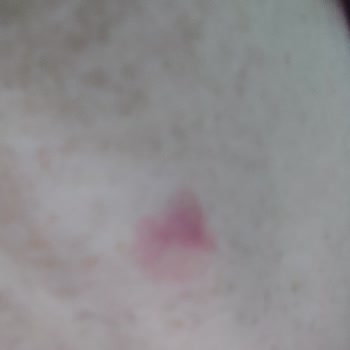 Bee Beauty Yüz Temizleme Jelinde Şiddetli Kuruluk Ve Kızarıklık Şikayetim