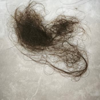 Biotin Kafein Şampuanı Nedeniyle Aşırı Saç Dökülmesi Ve İade İsteği