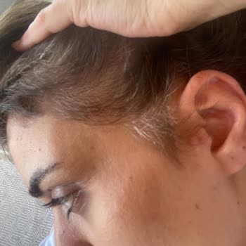 L’Oreal Saç Boyası Beyazları Kapatmadı Ve Ücret İadesi Talebi