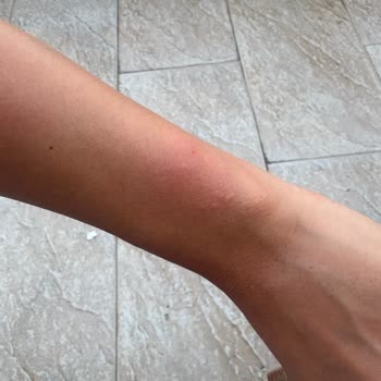 Saat & Saat DKNY Saatinde Alerjik Reaksiyon ve Garanti Gecikmesi Nedeniyle İade Talebi