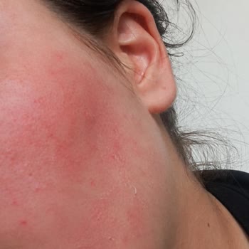 Cildimde Şiddetli Tahriş Ve Yanma: La Roche Posay Kremi
