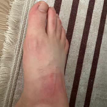 Adidas Cloudfoam Caused Foot Injury After First Use