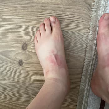 Adidas Cloudfoam Caused Foot Injury After First Use