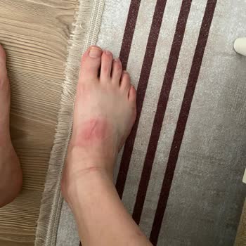Adidas Cloudfoam Caused Foot Injury After First Use