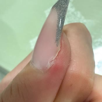 Enfeksiyonlu Tırnak Uygulaması Ve İlgisiz Yaklaşım
