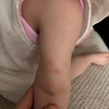 Mustela Losyonunda Bebekte Şiddetli Kızarıklık Ve İade Talebi