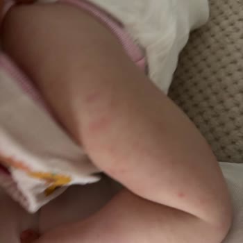 Mustela Losyonunda Bebekte Şiddetli Kızarıklık Ve İade Talebi