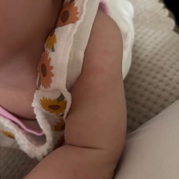 Mustela Losyonunda Bebekte Şiddetli Kızarıklık Ve İade Talebi