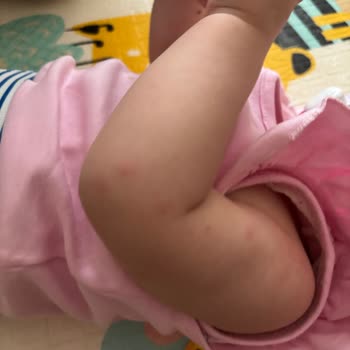 Mustela Losyonunda Bebekte Şiddetli Kızarıklık Ve İade Talebi