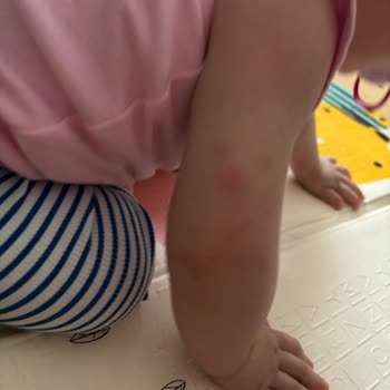 Mustela Losyonunda Bebekte Şiddetli Kızarıklık Ve İade Talebi