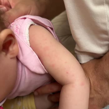 Mustela Losyonunda Bebekte Şiddetli Kızarıklık Ve İade Talebi