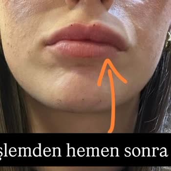 Kadıköy Klinik'te Asimetrik Dudak Dolgusu Ve İade İsteği