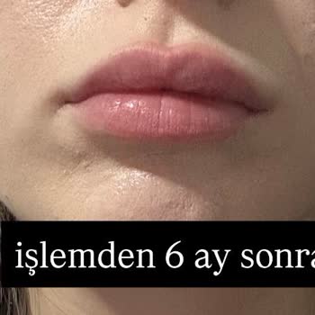 Kadıköy Klinik'te Asimetrik Dudak Dolgusu Ve İade İsteği