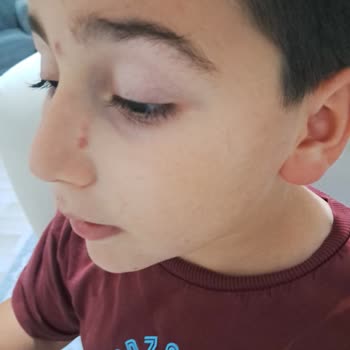 Çocuk Gözlüğü Çerçevesi Ciltte Tahriş Oluşturdu, Ücretsiz Değişim Talebi