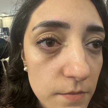 Kına Salonunda Patlayan Konfeti Tıpası Gözümde Şişti Ve Yetkililer Cevap Vermedi