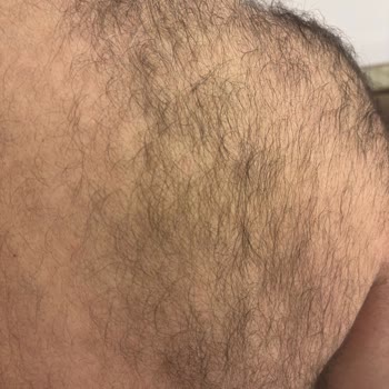 Esse Life Başakşehir Cilt Bakımında Roza ve Lazer Epilasyonda Etkisizlik