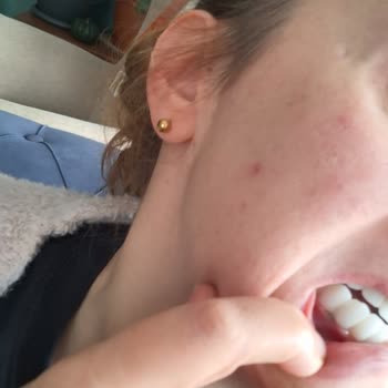 Yanlış Implant Yerleşimi Ve Kırılan Zirkonyum Dişler Nedeniyle 1,5 Yıllık Mağduriyet