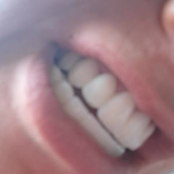 Yanlış Implant Yerleşimi Ve Kırılan Zirkonyum Dişler Nedeniyle 1,5 Yıllık Mağduriyet