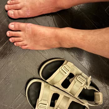Şiddetli Ayak Yarası Yaratan Birkenstock Sandaleti İçin İade İsteği