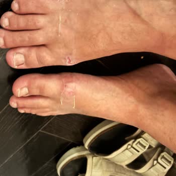 Şiddetli Ayak Yarası Yaratan Birkenstock Sandaleti İçin İade İsteği
