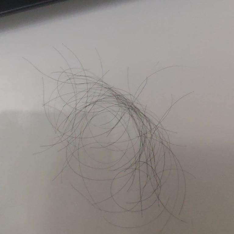 Fix Hair Umraniye'de Amatör Tedavi, Saç Dökülmesi Ve İade İhlali