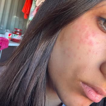 L’Oréal Bright Reveal SPF50 Güneş Kremi Alerjik Reaksiyon Yarattığı İçin Satıştan Kaldırılmalı