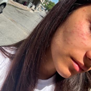 L’Oréal Bright Reveal SPF50 Güneş Kremi Alerjik Reaksiyon Yarattığı İçin Satıştan Kaldırılmalı