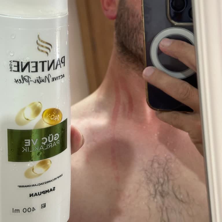 BİM Birleşik Mağazalar'dan Alınan Pantene Şampuanı Deride Şiddetli Kabarma Ve Kızarıklık Yarattı