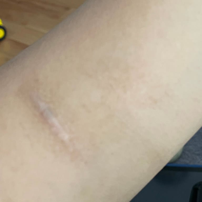 Lazer Silme İşleminde Yanık, Sonuçsuz Seanslar Ve Ücret İadesi Talebi