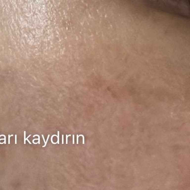Pervin Dinçer Beauty Yüzümde Yeni Ve Daha Belirgin Bir Leke İle Kaldım