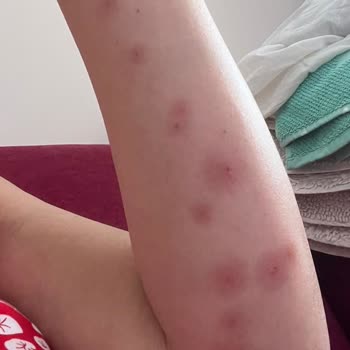 Hamile Uyku Yastığından Şiddetli Alerjik Reaksiyon Ve Sağlık Riski