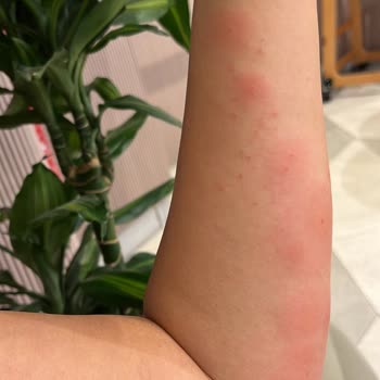 Hamile Uyku Yastığından Şiddetli Alerjik Reaksiyon Ve Sağlık Riski