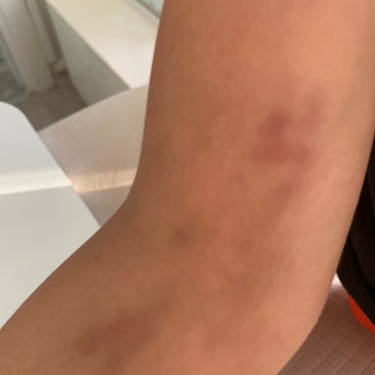 Kan Alırken Uygulanan Baskı Çocuğumun Kolunda Morluk Bıraktı
