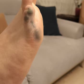 Renk Sızdıran Ayakkabıda Kullanıcı Hatası İddiası Ve Sorumsuz Müşteri Hizmetleri