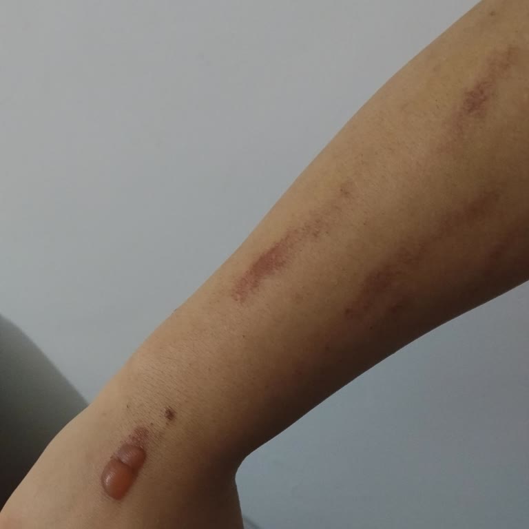 Lavinya Golden Malatya Laser Epilasyon Sonrası Şiddetli Yanık Ve İlgisizlik