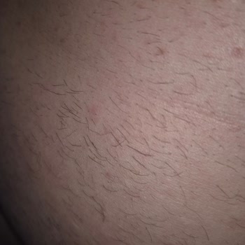 Livavip Merkezinde Yanık Oluşan Lazer Epilasyon Ve Etik Dışı Satış Uygulamaları