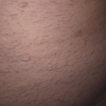 Livavip Merkezinde Yanık Oluşan Lazer Epilasyon Ve Etik Dışı Satış Uygulamaları