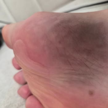 Ankamall Elle Sandaletlerinde İlk Kullanımda Şiddetli Yanma Ve Su Toplanması