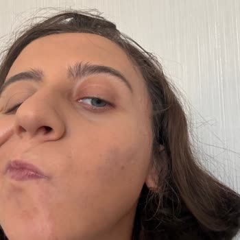 Müjgan Siyah Nokta Aleti Kullanımından Sonra Yüzde Şiddetli Morluklar