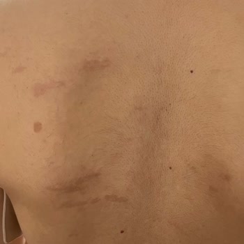 Lazer epilasyon sonrası yanık ve mağduriyet şikayeti