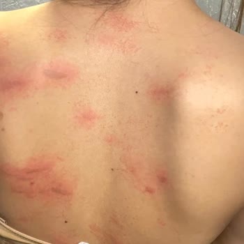 Lazer epilasyon sonrası yanık ve mağduriyet şikayeti