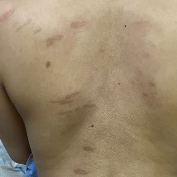 Lazer epilasyon sonrası yanık ve mağduriyet şikayeti